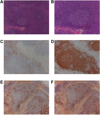 Histopathological findings in a specimen of the right lacrimal gland. H&E staining at low magnification (A x 100) and high magnification