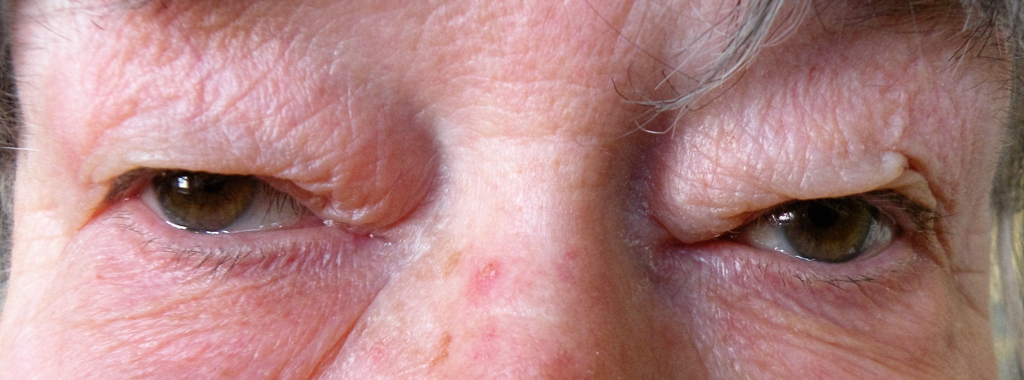 Dermatochalasis with redundant upper eyelid skin