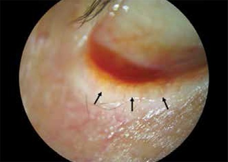 A patient with eyelash loss due to chronic blepharitis. The mucocutaneous junction has anteriorized beyond the meibomian