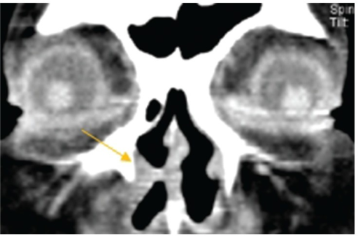 A 70-year-old female patient with <b>epiphora</b> in both eyes. She had a previous history of nasal trauma. When examini