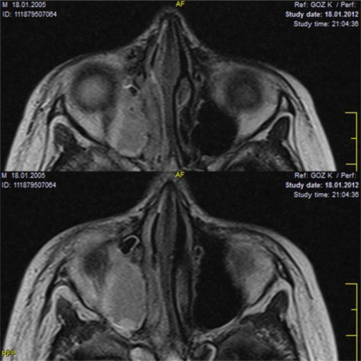 <b>Orbital cellulitis</b> as a first sign of underlying KD.