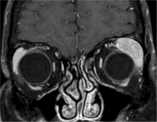 MRI of <b>orbital</b> tumor.