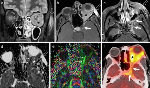 35-year-old female patient with painful proptosis, loss of vision, and subcutaneous facial swelling. Biopsy of the face 