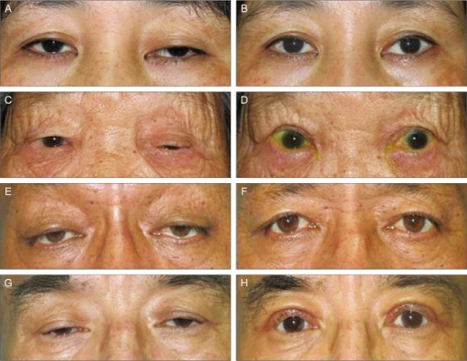 Clinical photographs of patients with blepharoptosis showing upper eyelid drooping
