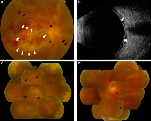Fundus photographs at initial presentation and after intravenous acyclovir therapy. (A) Initial fundus examination revea