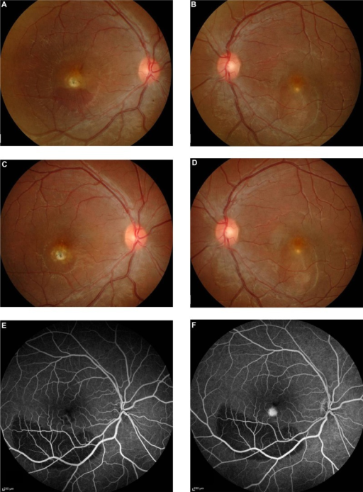 Color fundus photograph and fluorescein angiography showing submacular hemorrhage in wet AMD