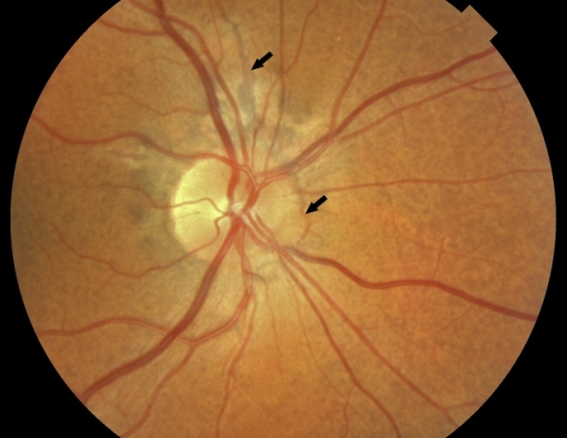 Clinical optical features of pseudoxanthoma elasticum. 141514The retina of the right eye of case 5 shows peau d'orange (