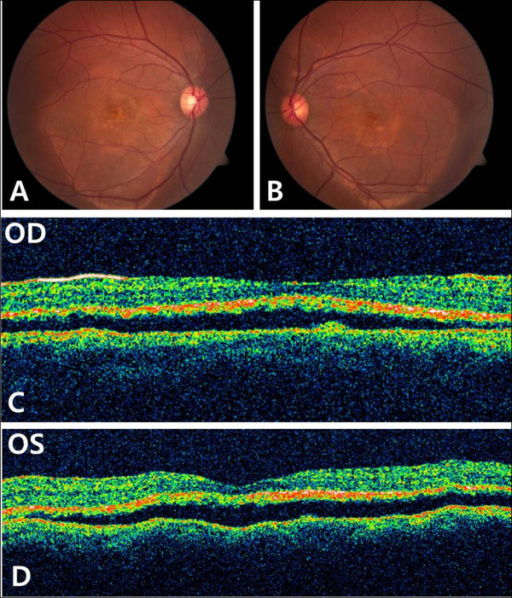 Case 1. Fundus photographs and optical cohenrece tomography (OCT) at initial presentation. A,B, Fundus photographs showe