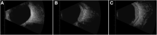 B-scan of both eyes. (A) Normal eye, OD, (B) longitudinal, and (C) transverse of OS showing diffuse <b>choroidal</b> thi