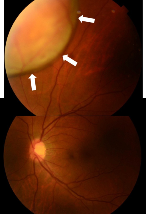 Fundus examination of the left eye showing a well‐circumscribed yellowish‐white <b>choroidal</b> mass at the inner upper