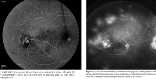 Case 1: central and peripheral lesions. (a) Color fundus photograph of the left eye. The upper temporal quadrant shows a