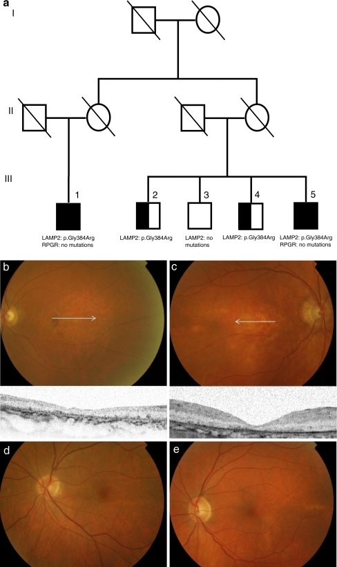 The pedigree, fundus photographs, spectral-domain optical coherence tomography (SD-OCT), electroretinogram (ERG) and a s