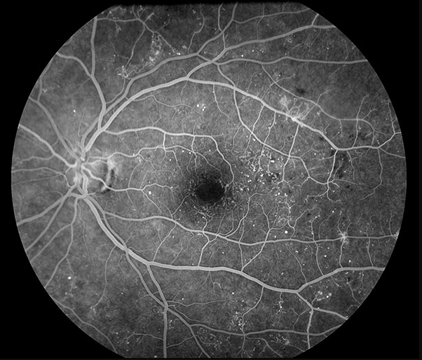 당뇨망막병증 — 형광안저촬영(FAG)