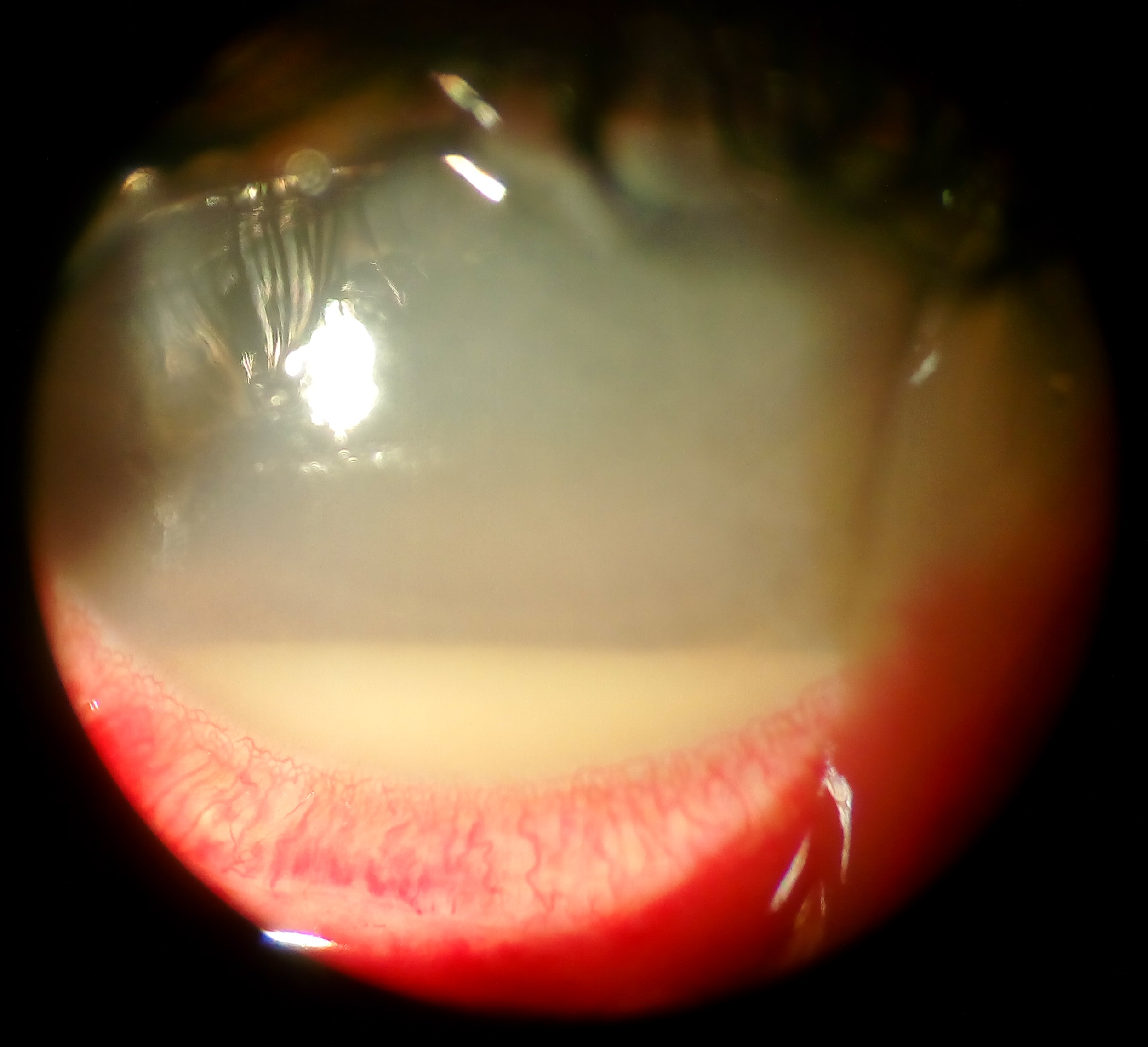 Hypopyon in endophthalmitis