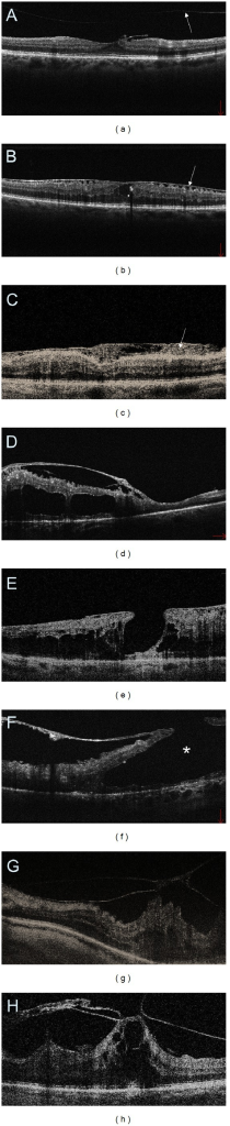SD-OCT cross-sectional images of macular vitreoretinal interface abnormalities