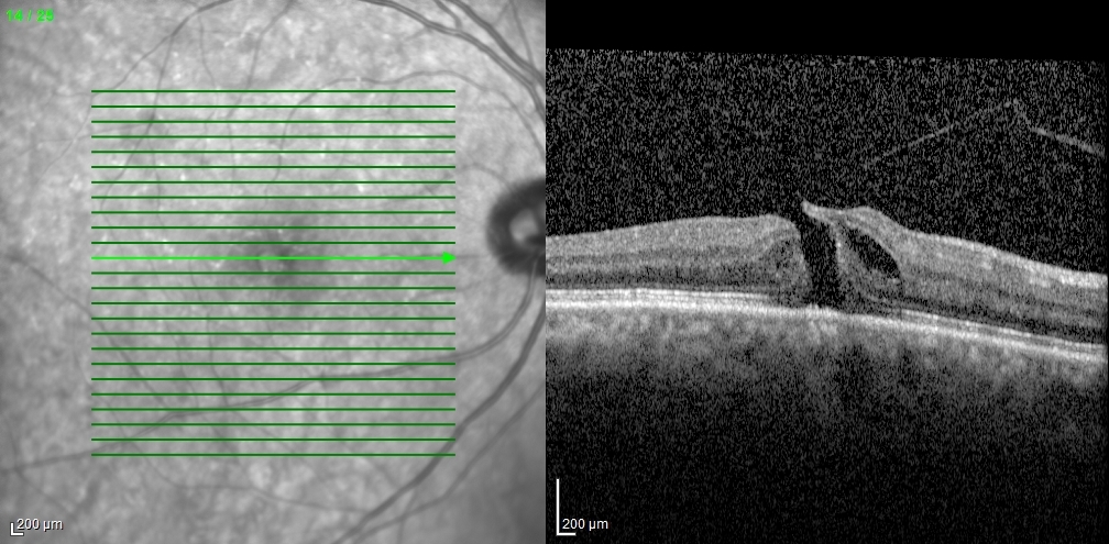 Full-thickness macular hole fundus photograph