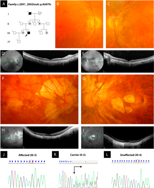 Pedigree of a non-consanguineous family with X-linked retinitis pigmentosa (RP) and pathologic <b>myopia</b> (PM), retin