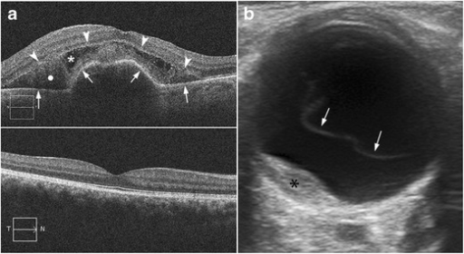 Neovascular age-related macular degeneration. a Top image: optical coherence tomography (OCT) image in a patient with ac
