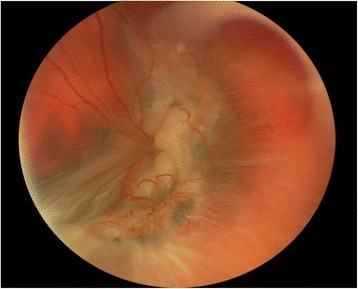 Fundus photograph showing a <b>star fold</b> from a <b>proliferative vitreoretinopathy</b> in a patient with a history o