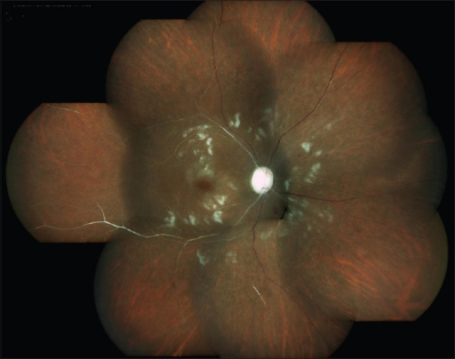 Branch retinal artery occlusion (BRAO) fundus photograph showing sectoral retinal whitening