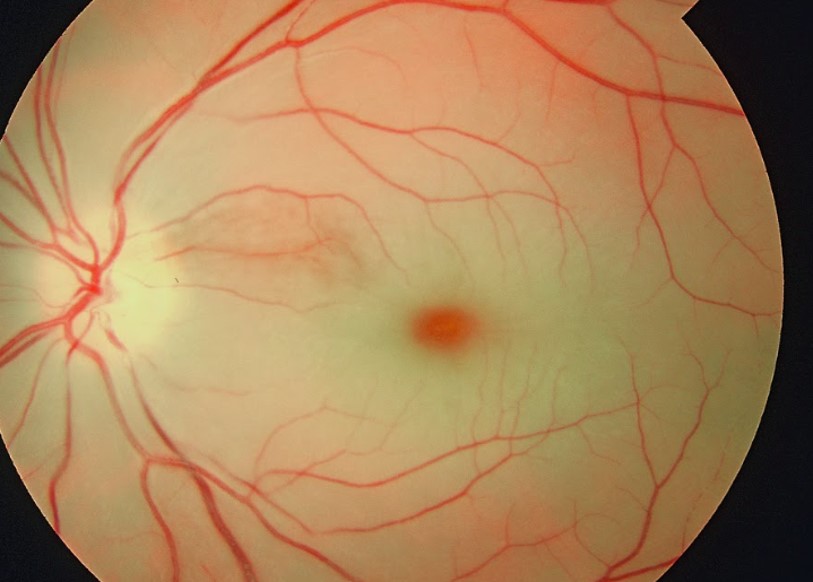 Cherry red spot in central retinal artery occlusion