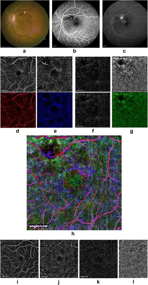 Fundus photography image a and early b and late c fluorescein angiogram showing a superotemporal <b>RAM</b>. OCT angiogr