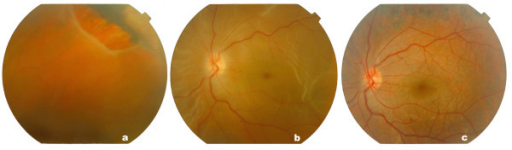 Colour images of the <b>retina</b> before and after operation. (a and b) Giant <b>retinal tear</b> with shallow detached