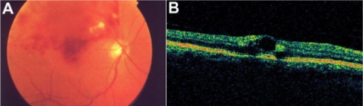 BRVO fundus photograph showing sectoral hemorrhages along affected vein branch