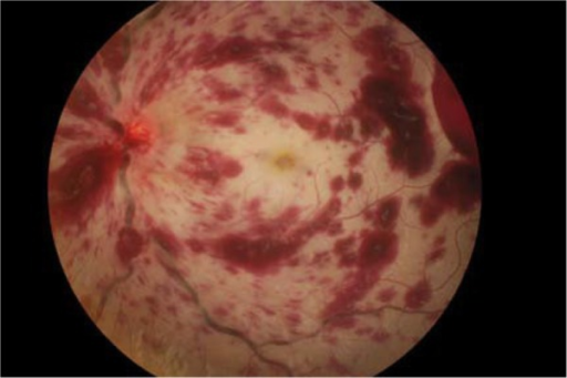 CRVO fundus with extensive flame-shaped hemorrhages, dilated veins, and disc edema