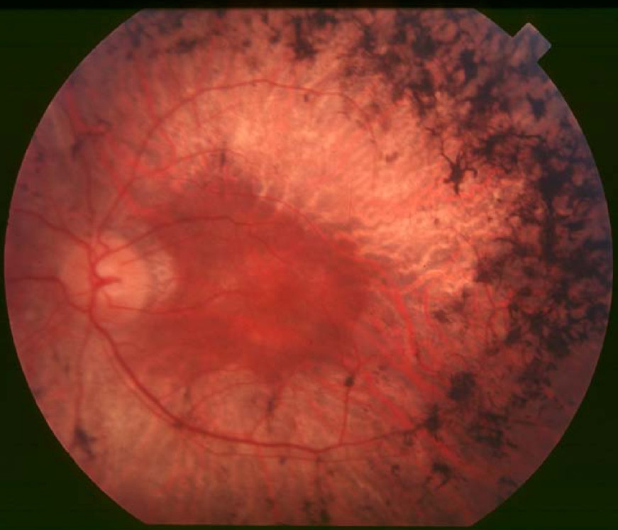 Fundus photograph of retinitis pigmentosa showing bone-spicule pigmentation