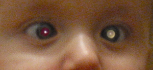 Leukocoria (white pupil reflex) in retinoblastoma