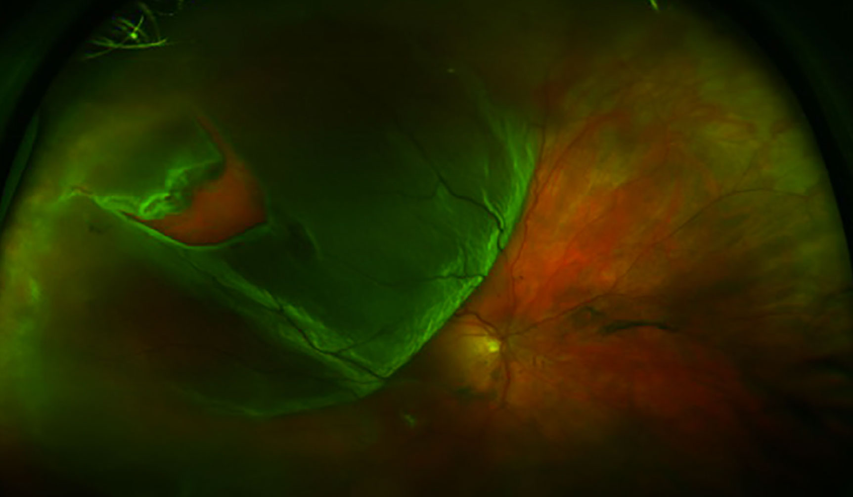 Rhegmatogenous retinal detachment fundus photograph