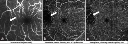 Conventional fluorescein angiography (FA, a) in comparison to optical coherence tomography angiography (OCTA) images of 