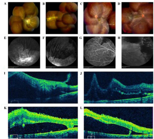 Ocular fundus images from a patient with Terson syndrome with no cerebral hemorrhage. Color fundus photography showed pe