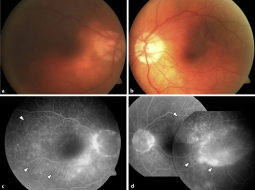 Fundus photographs of the patient at the second onset of VKH <b>disease</b> in June 2008 after the start of PEG-IFN and