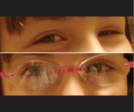 Patient in preferred head posture without (Left Panel) and with (Right Panel) hyperopic spectacle correction. Resolution