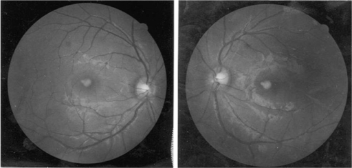 Fundus examination showed intorsion of the right eye.