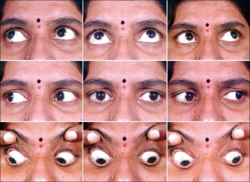 Clinical photograph pre injection showing the presence of comitant left <b>exotropia</b> in all the nine cardinal positi