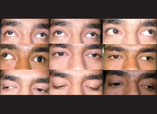 A 19-year-old boy with large-angle exotropia and limited ocular movements. Nine gaze pictures