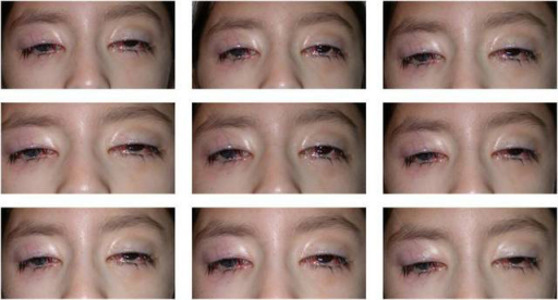 Subject in different fields of gaze. Motility examination demonstrates severe restriction in all fields of gaze. The onl